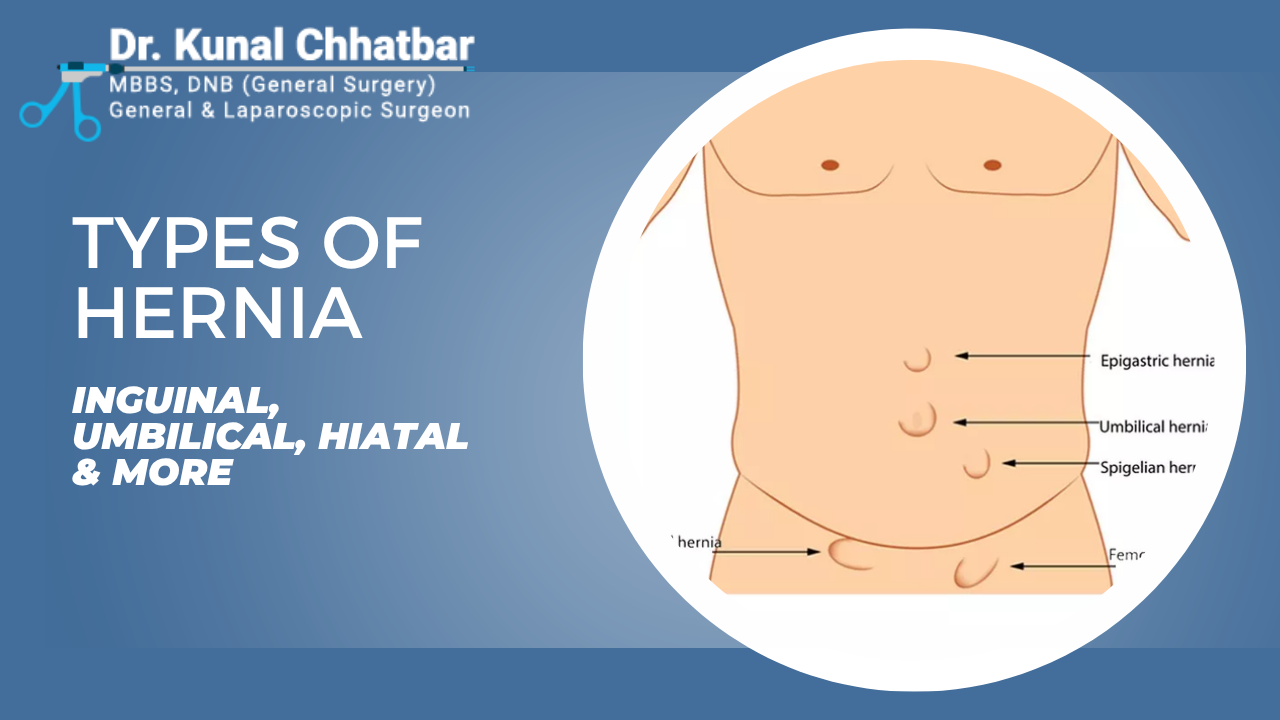 Types of Hernia